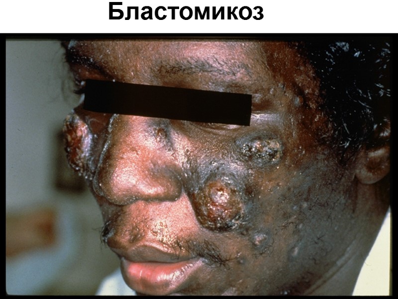 Бластомикоз